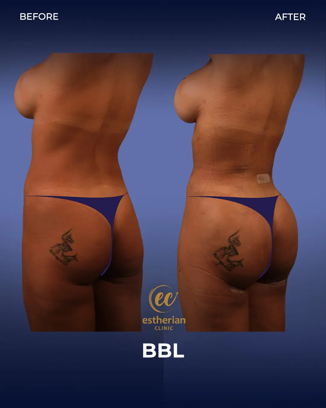 BBL - Brazilian Butt Lift Results by the Estherian Clinic