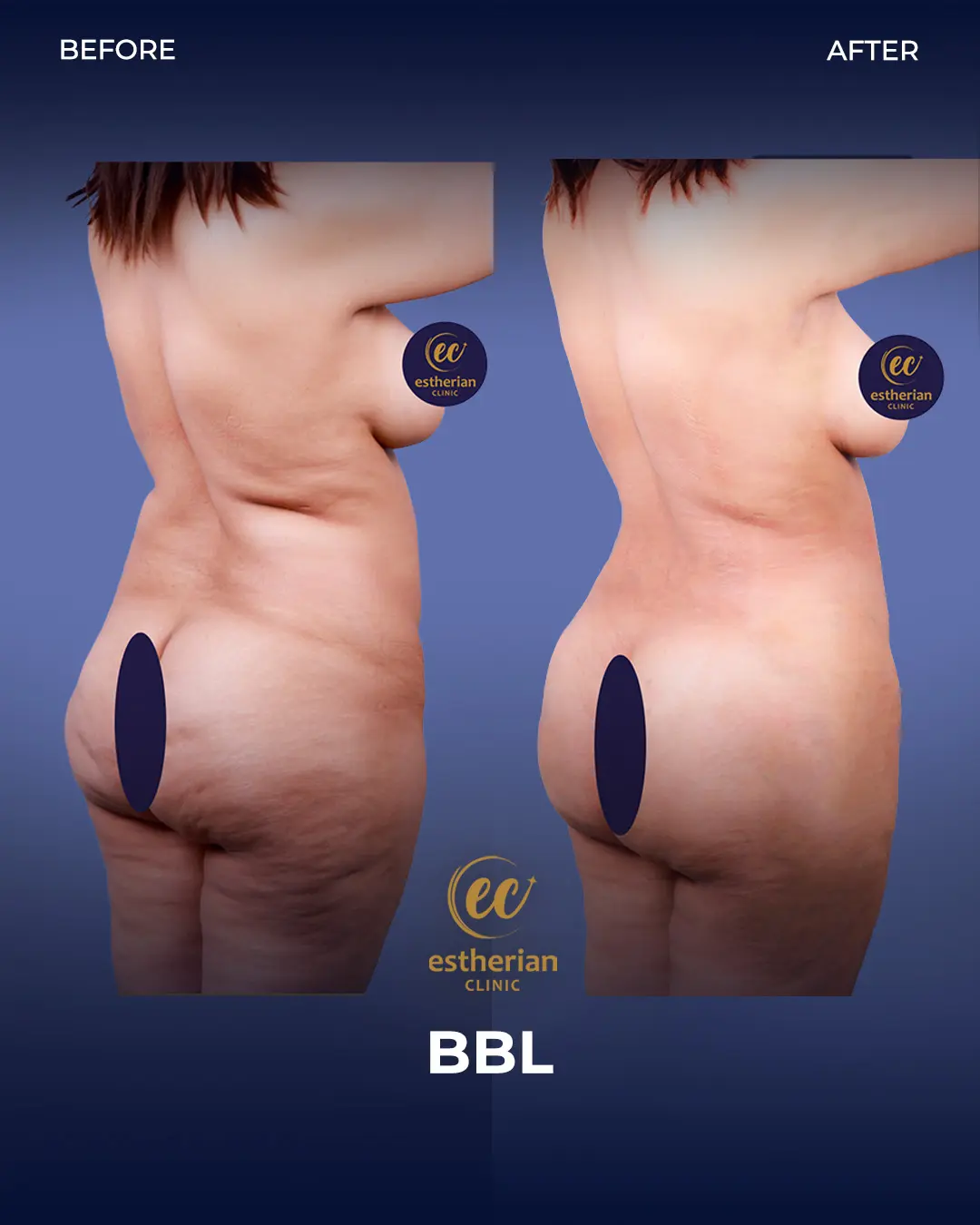 BBL - Brazilian Butt Lift Results by the Estherian Clinic