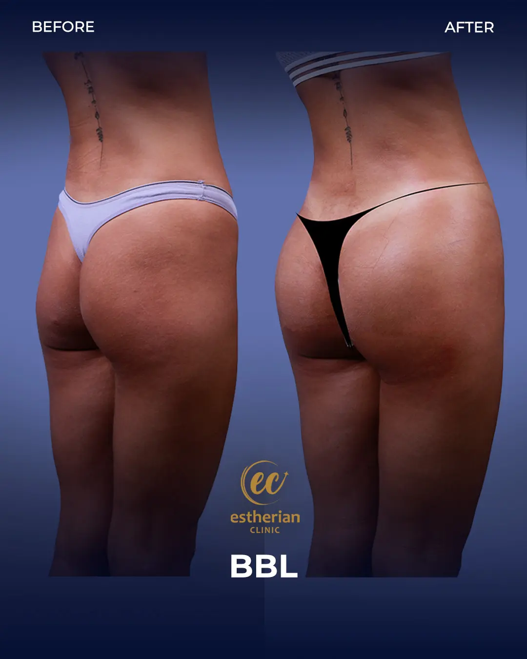 BBL - Brazilian Butt Lift Results by the Estherian Clinic