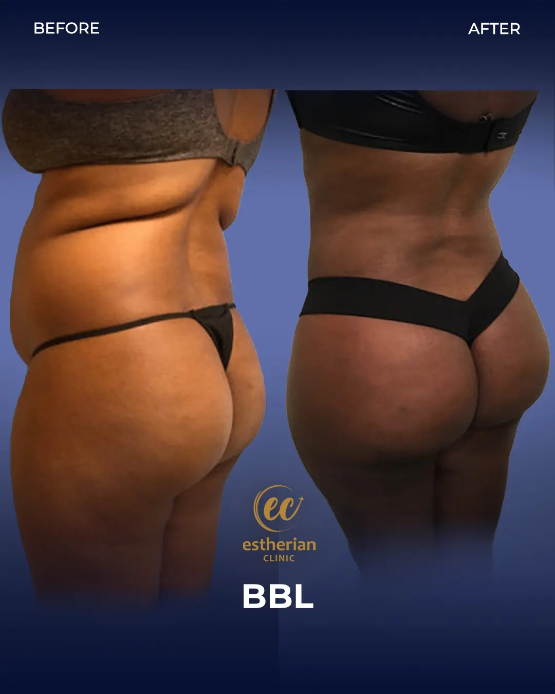 BBL - Brazilian Butt Lift Results by the Estherian Clinic