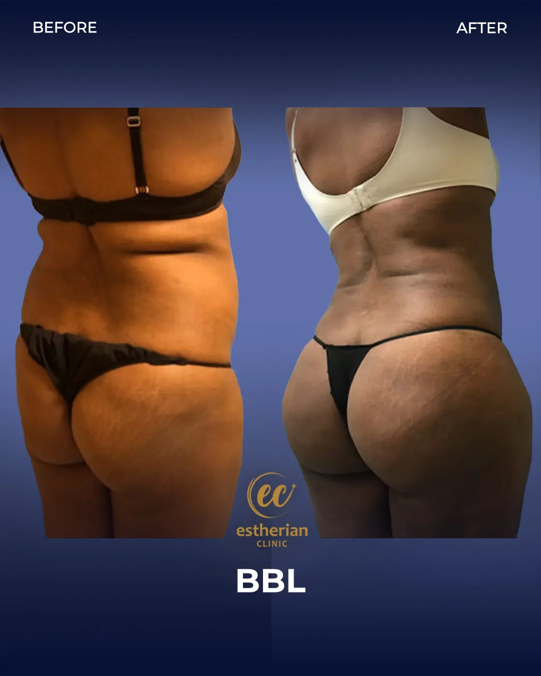 BBL - Brazilian Butt Lift Results by the Estherian Clinic