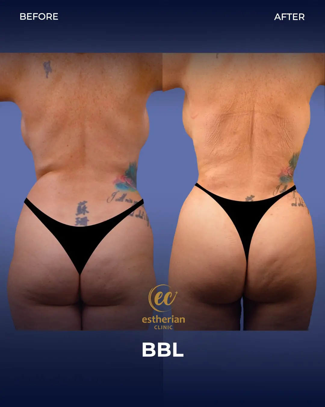 BBL - Brazilian Butt Lift Results by the Estherian Clinic