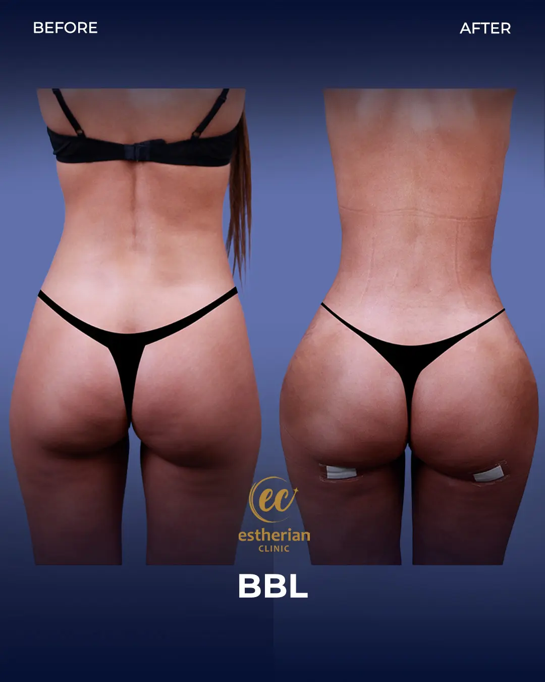 BBL - Brazilian Butt Lift Results by the Estherian Clinic