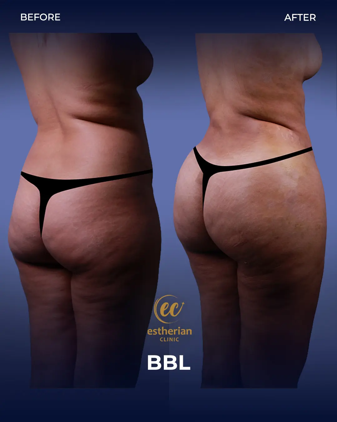 BBL - Brazilian Butt Lift Results by the Estherian Clinic
