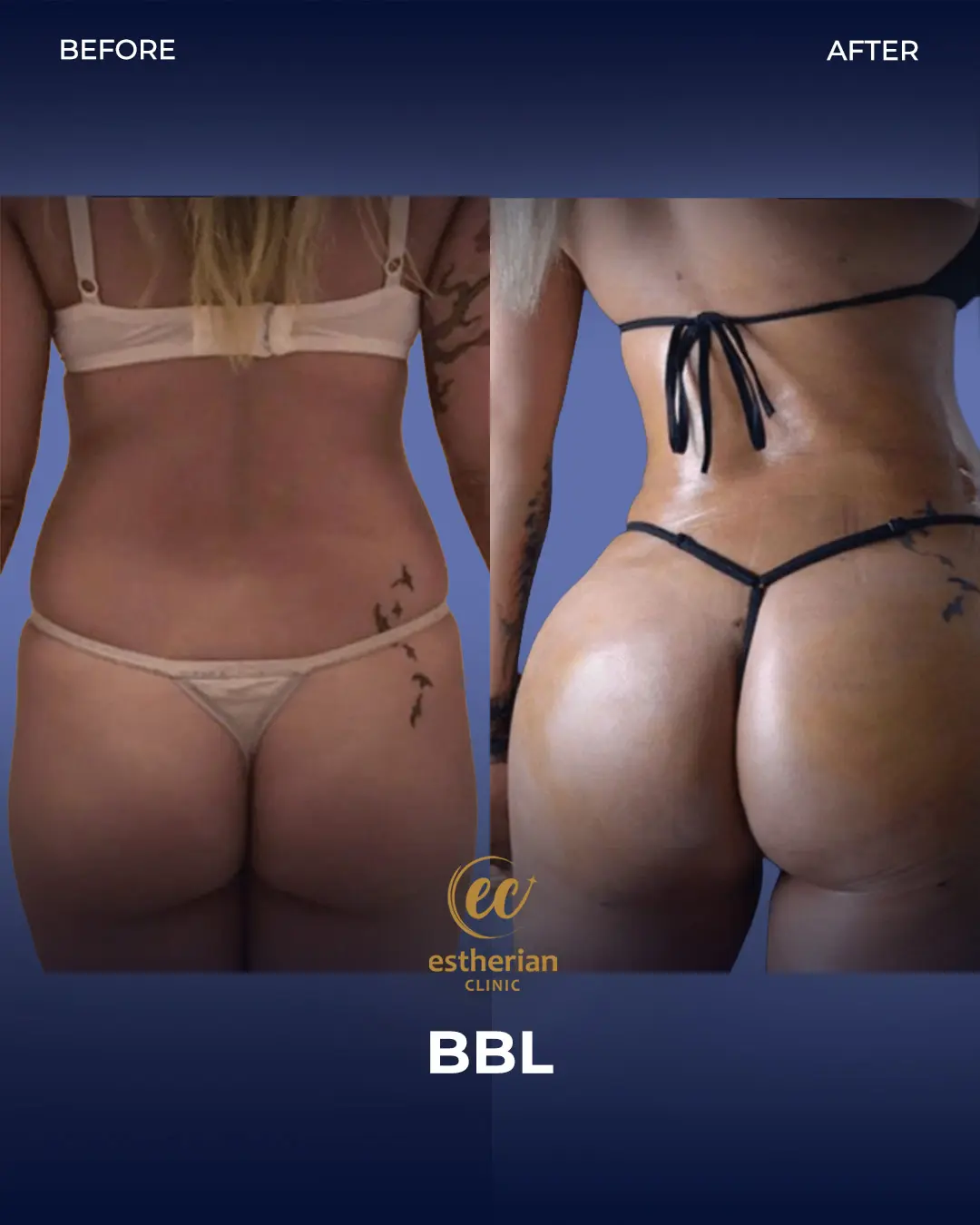 BBL - Brazilian Butt Lift Results by the Estherian Clinic