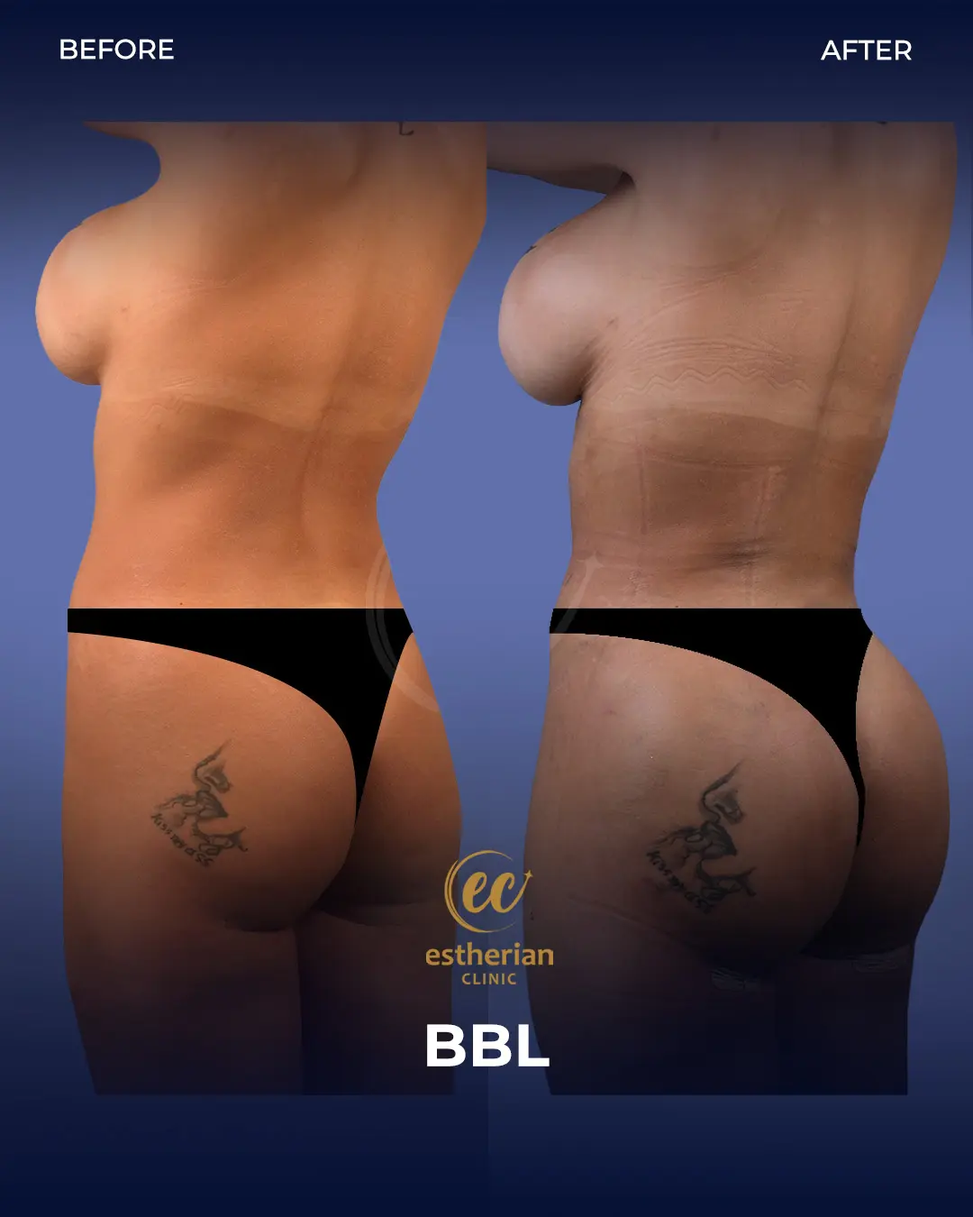 BBL - Brazilian Butt Lift Results by the Estherian Clinic
