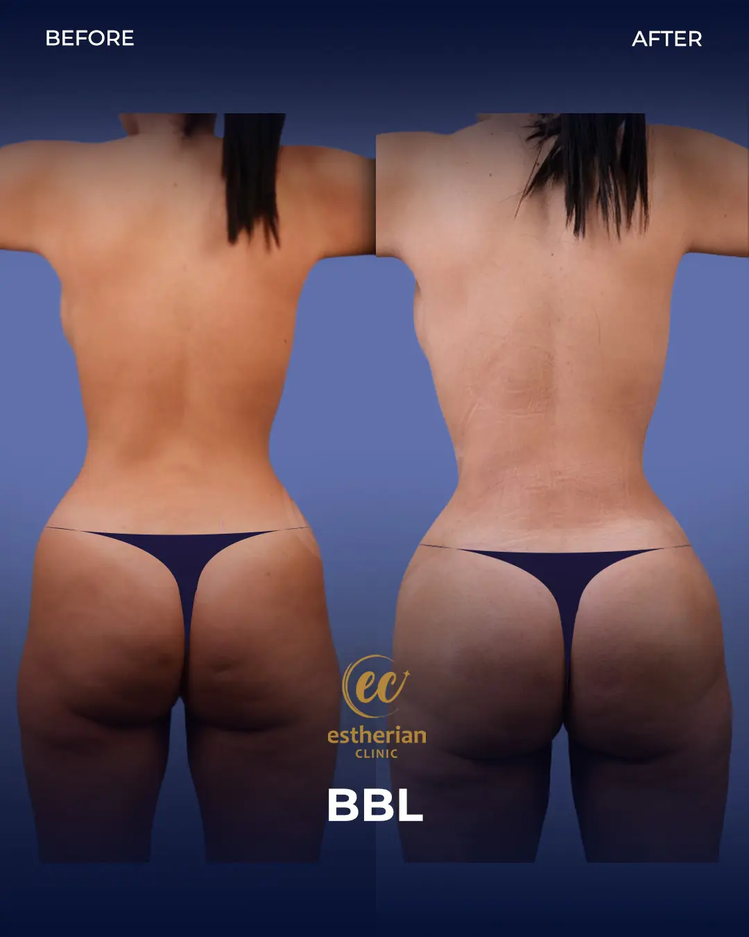 BBL - Brazilian Butt Lift Results by the Estherian Clinic