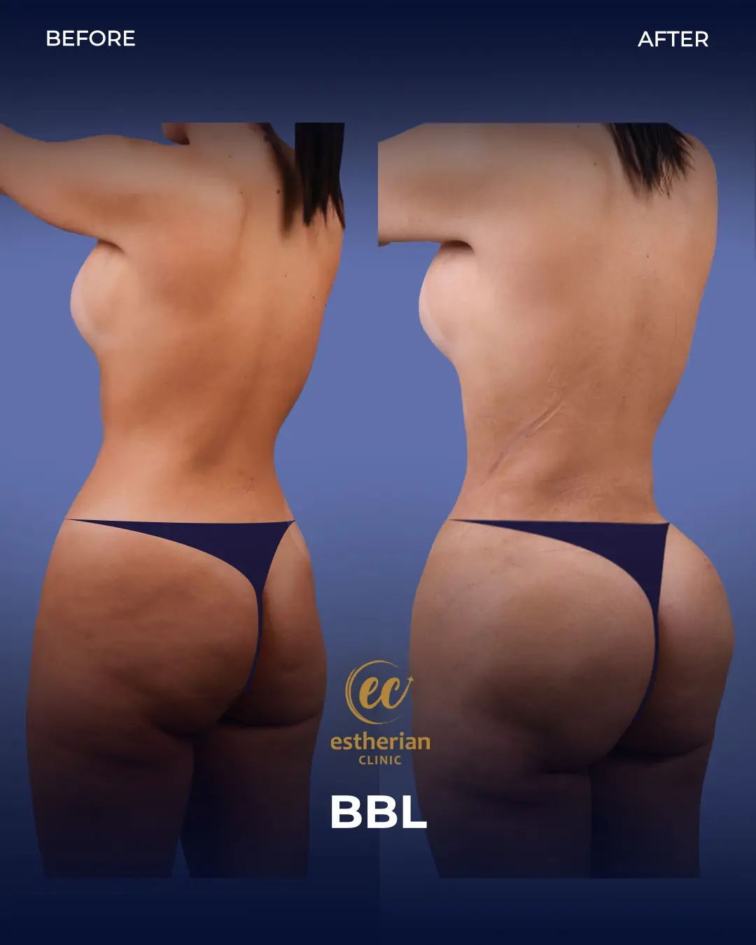BBL - Brazilian Butt Lift Results by the Estherian Clinic