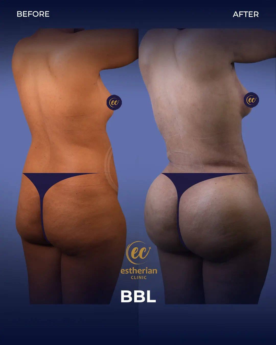 BBL - Brazilian Butt Lift Results by the Estherian Clinic