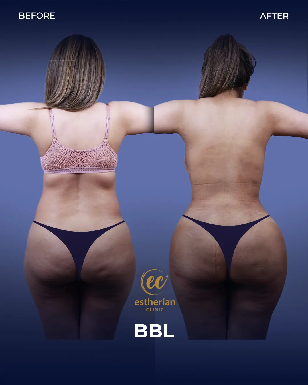 BBL - Brazilian Butt Lift Results by the Estherian Clinic