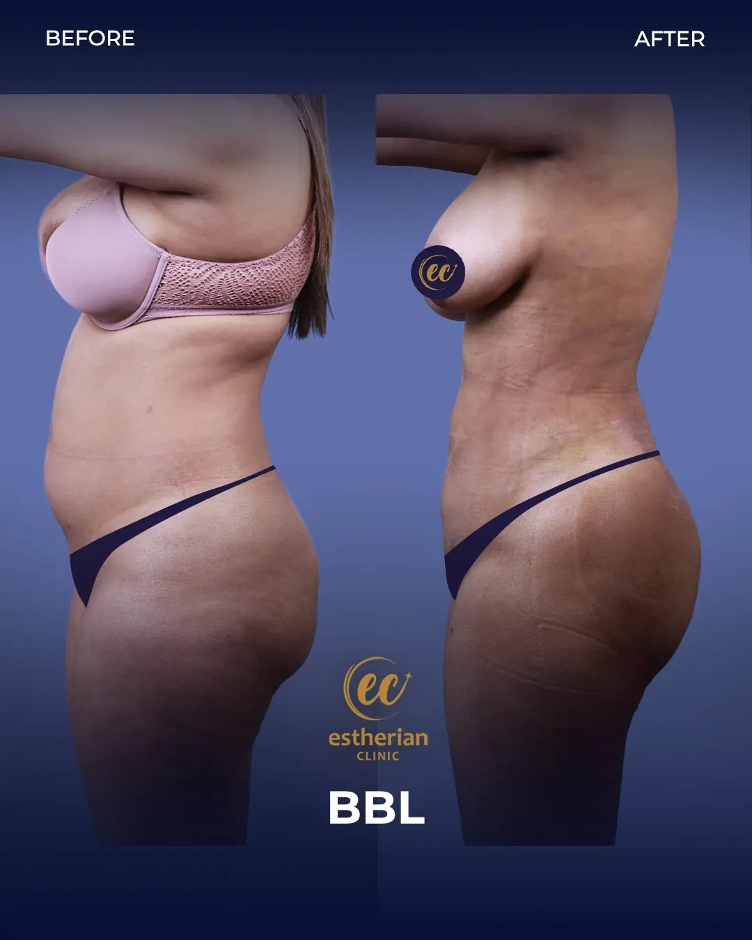 BBL - Brazilian Butt Lift Results by the Estherian Clinic
