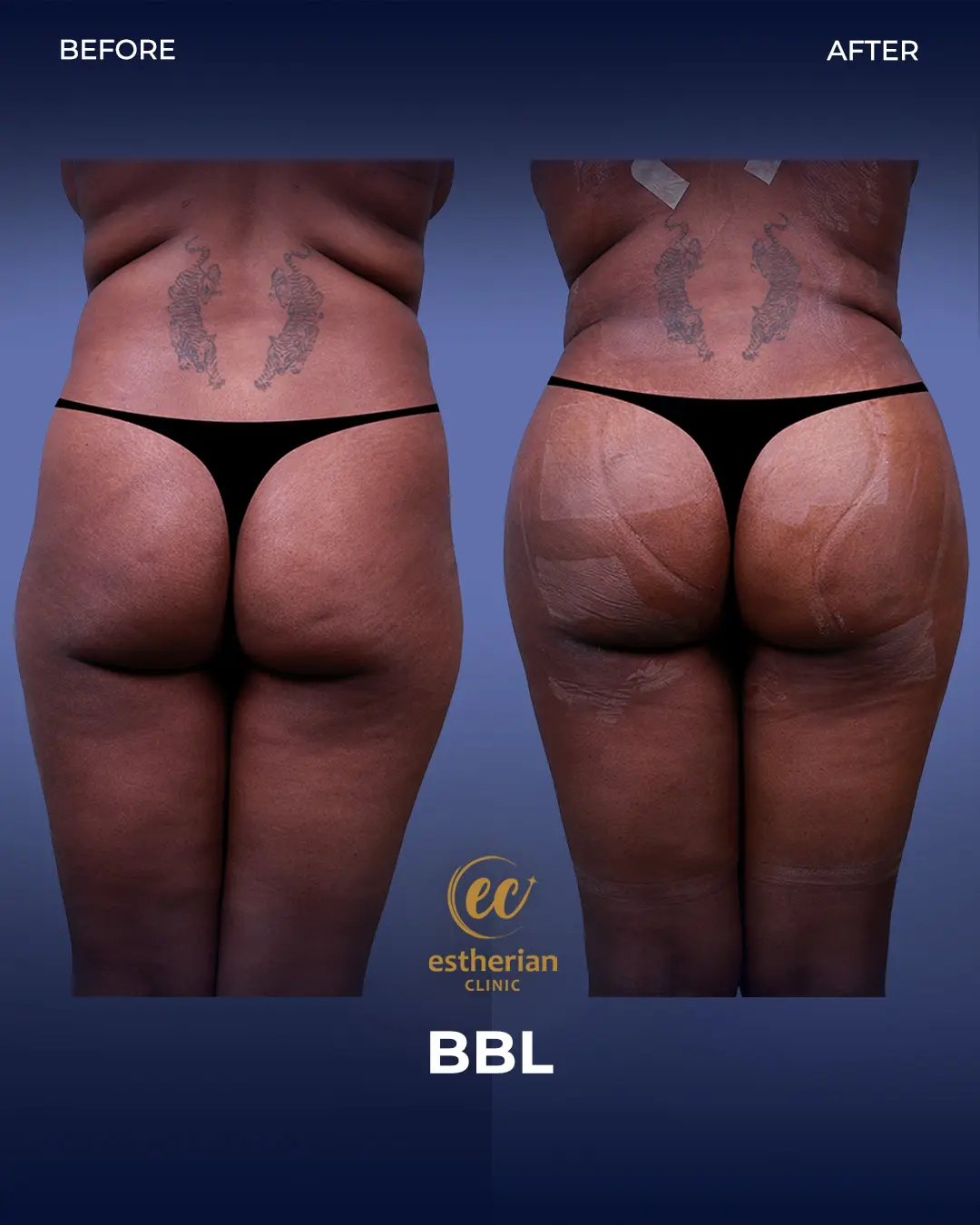 BBL - Brazilian Butt Lift Results by the Estherian Clinic