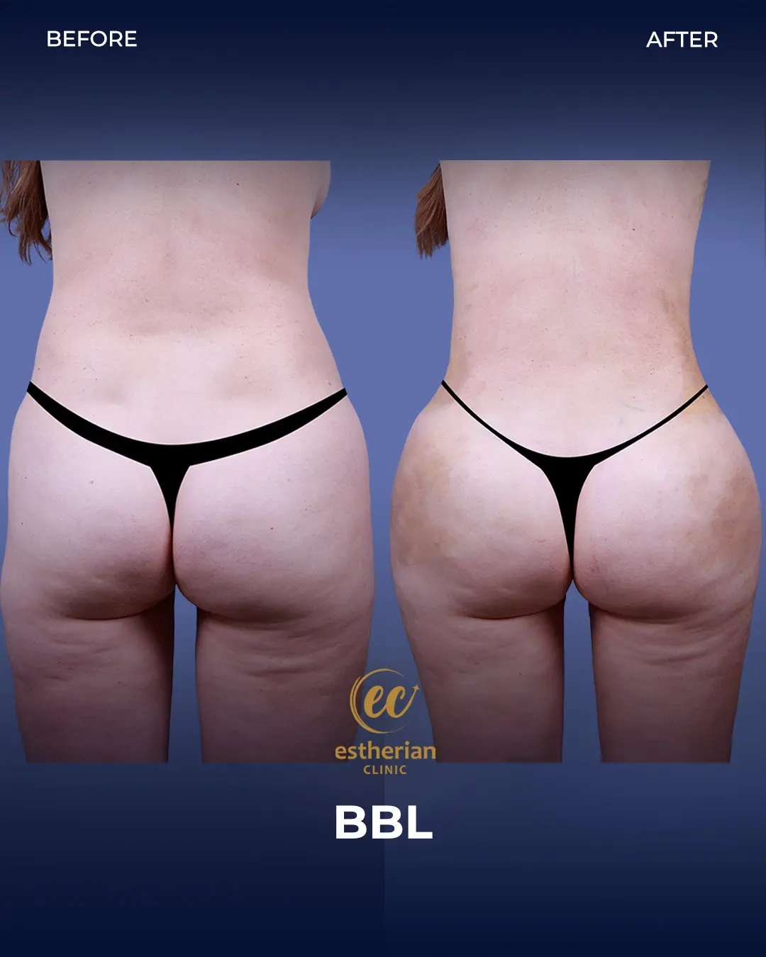 BBL - Brazilian Butt Lift Results by the Estherian Clinic