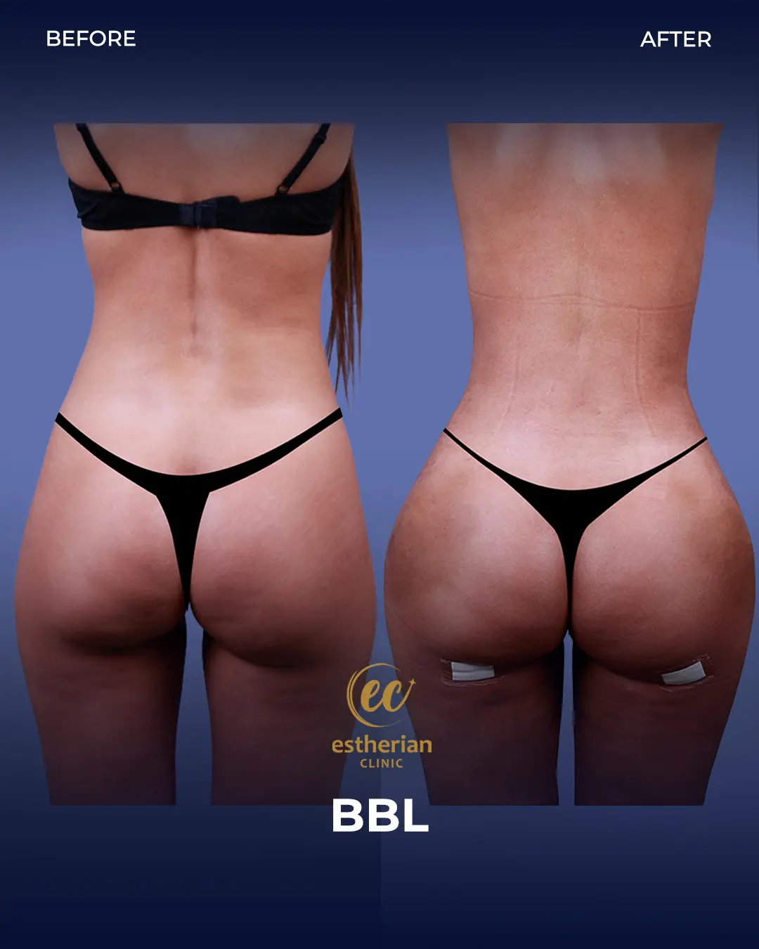 BBL - Brazilian Butt Lift Results by the Estherian Clinic