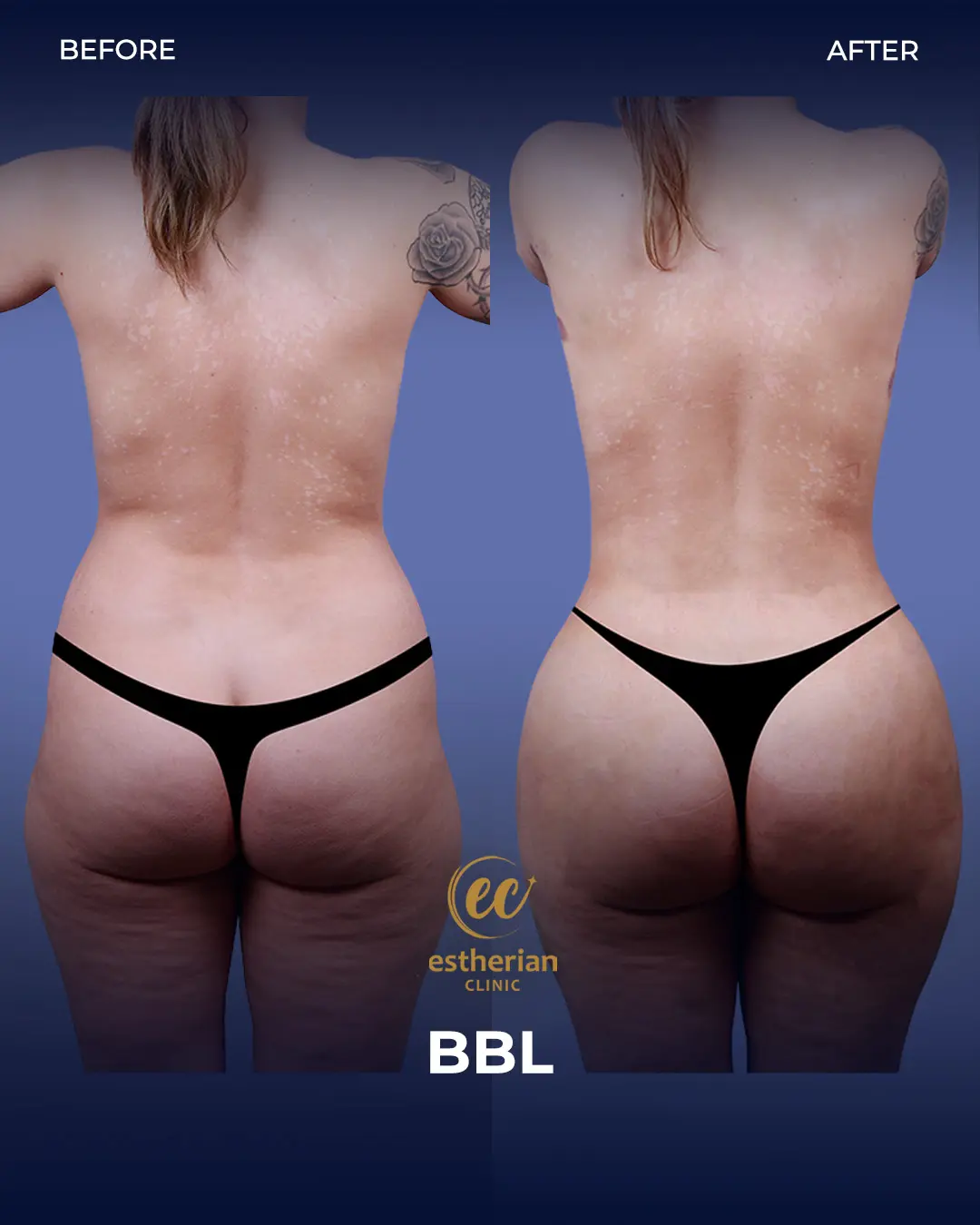 BBL - Brazilian Butt Lift Results by the Estherian Clinic
