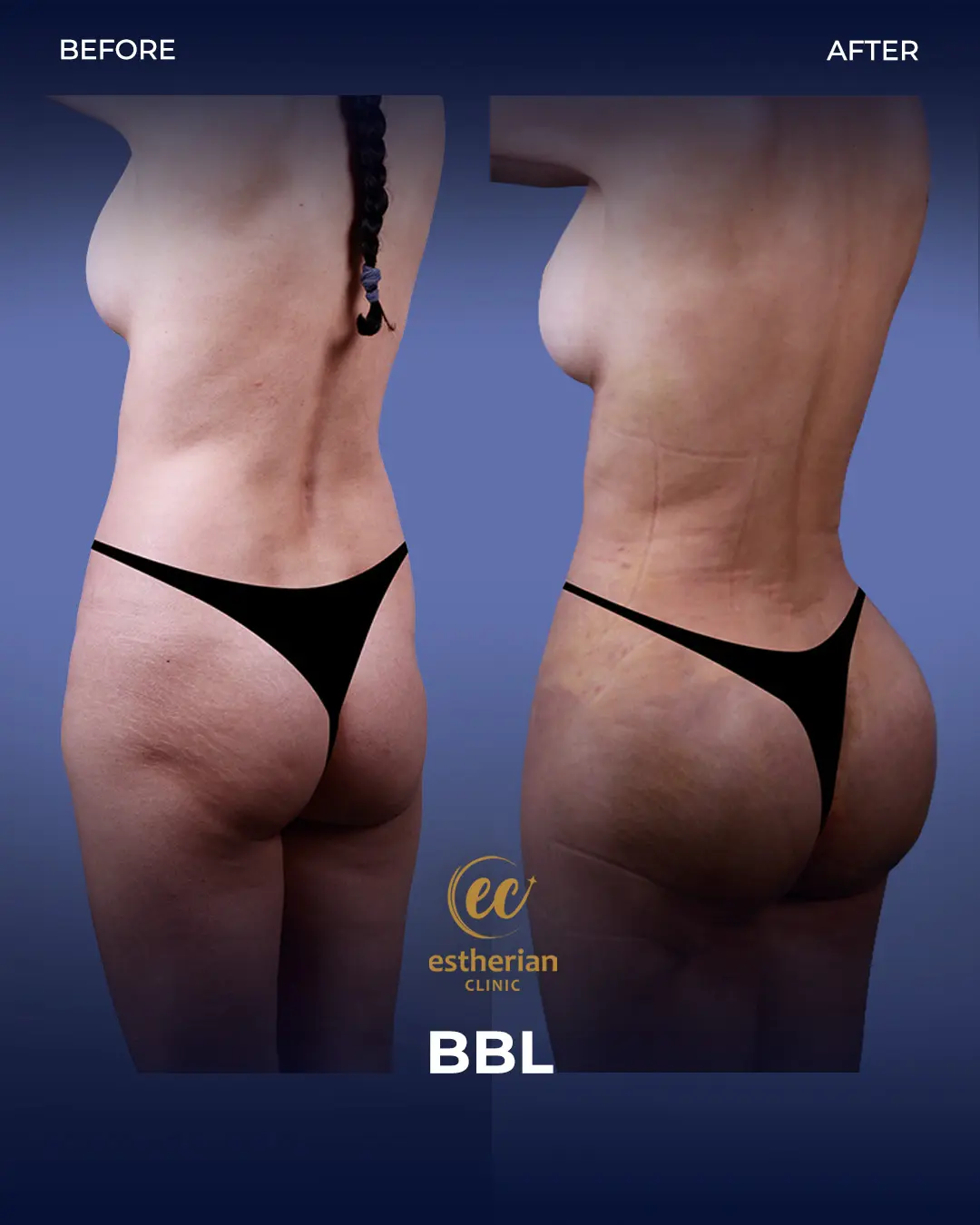 BBL - Brazilian Butt Lift Results by the Estherian Clinic