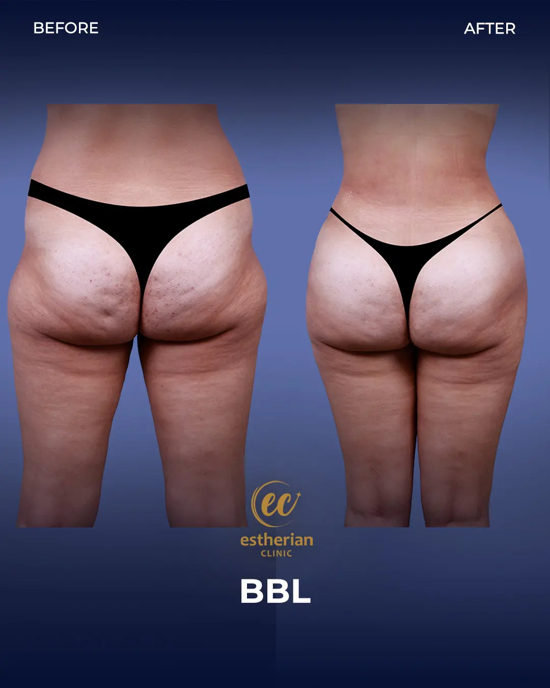 BBL - Brazilian Butt Lift Results by the Estherian Clinic