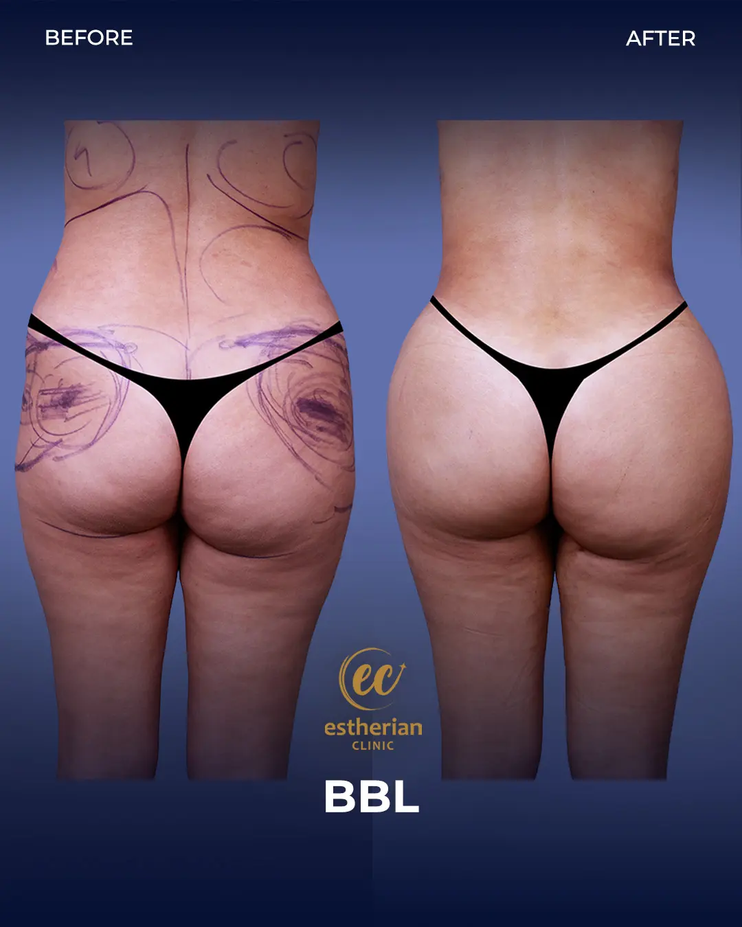 BBL - Brazilian Butt Lift Results by the Estherian Clinic