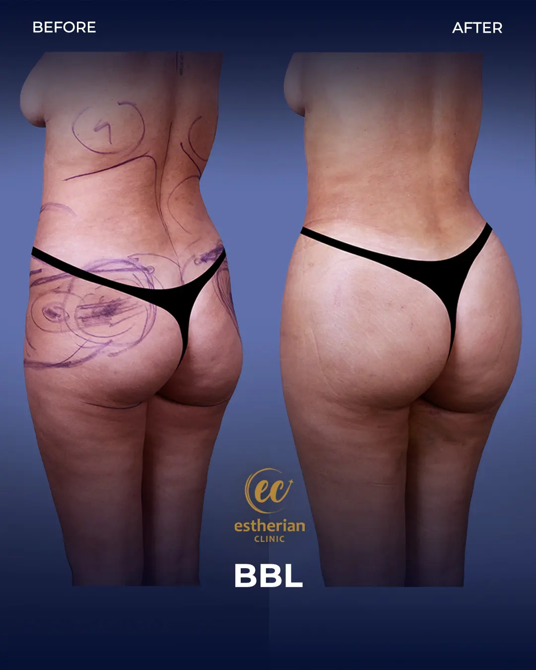 BBL - Brazilian Butt Lift Results by the Estherian Clinic