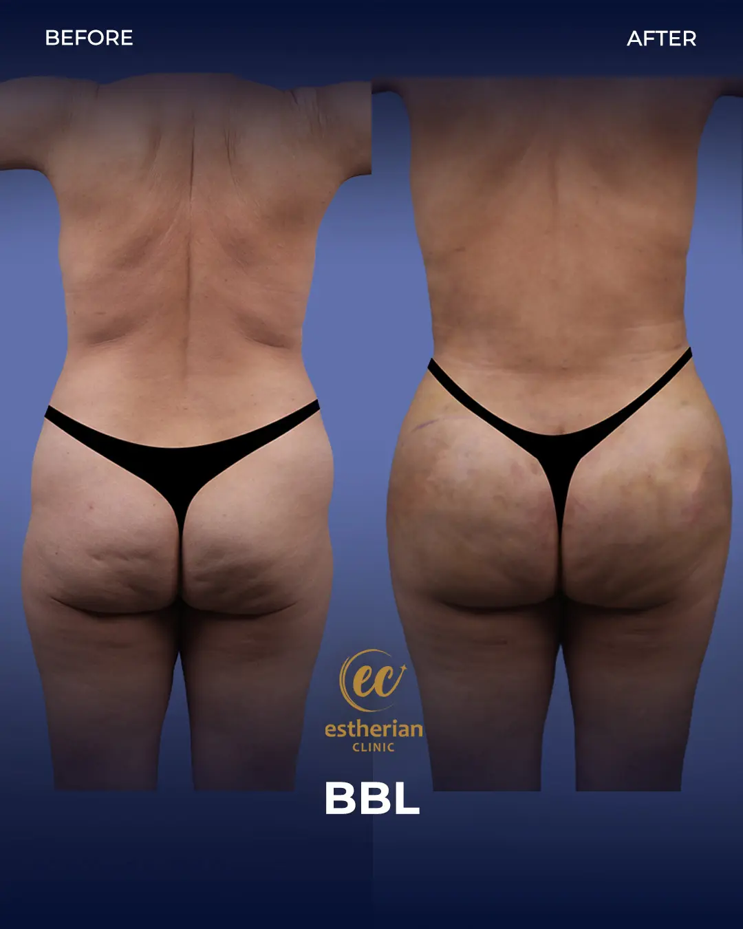 BBL - Brazilian Butt Lift Results by the Estherian Clinic