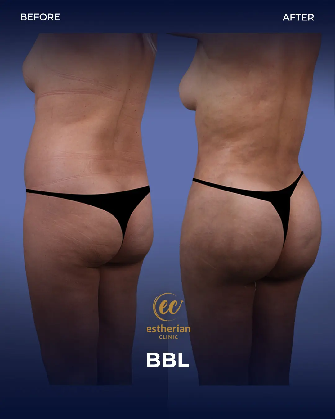 BBL - Brazilian Butt Lift Results by the Estherian Clinic