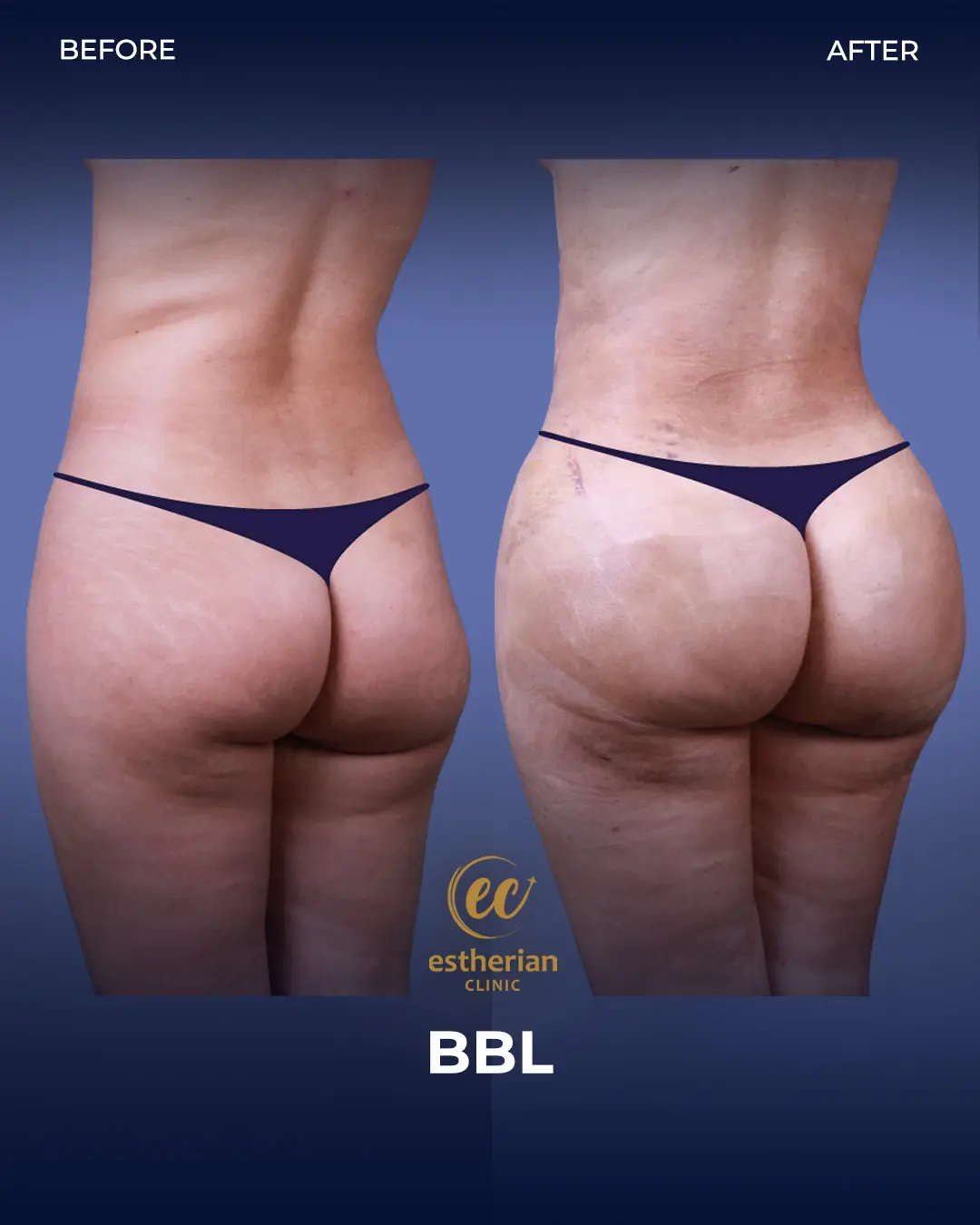 BBL - Brazilian Butt Lift Results by the Estherian Clinic