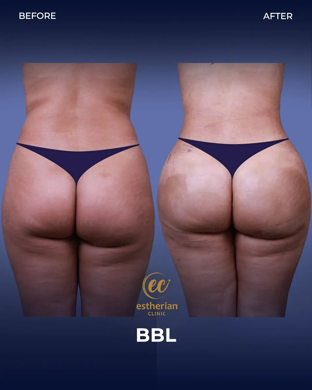BBL - Brazilian Butt Lift Results by the Estherian Clinic