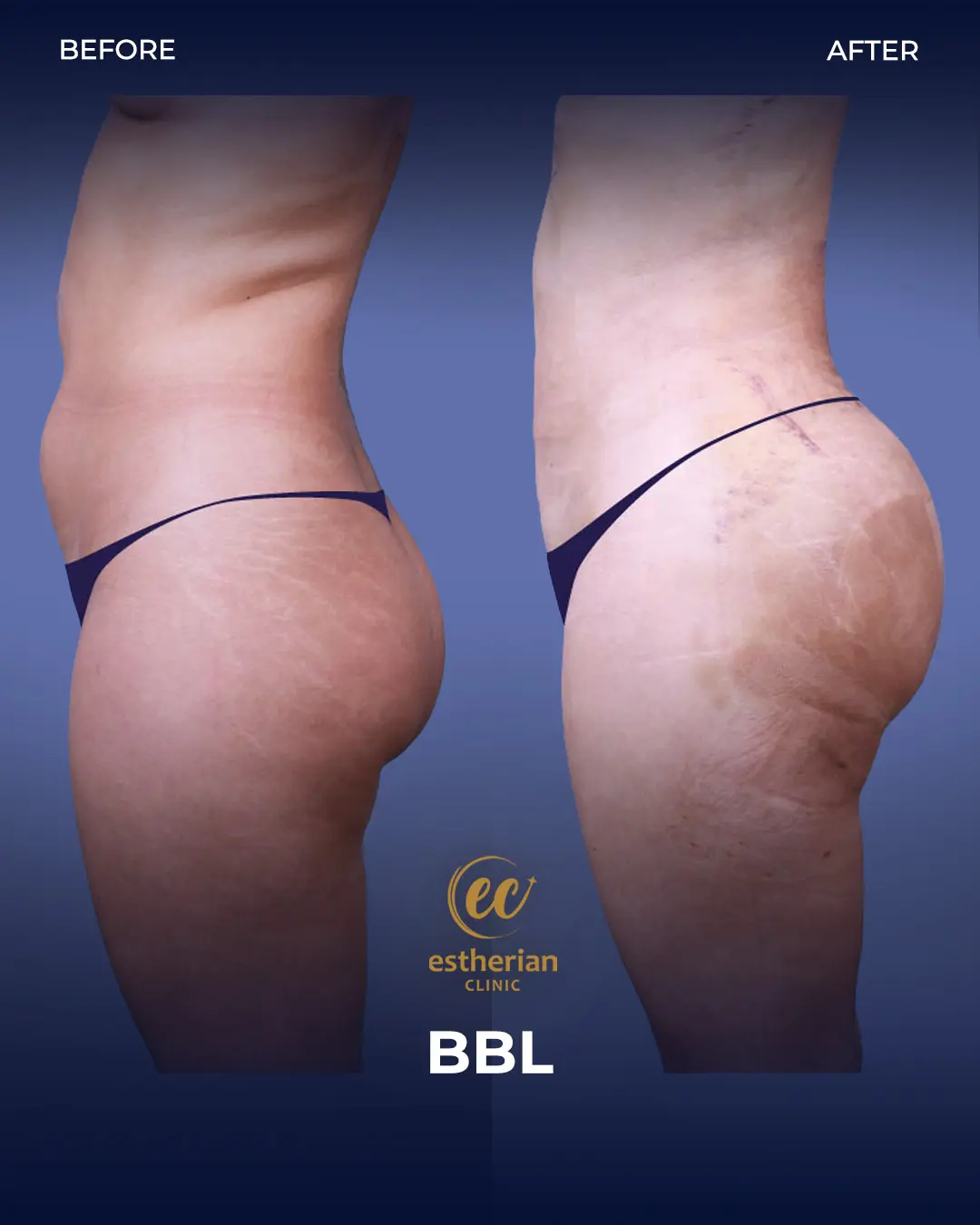 BBL - Brazilian Butt Lift Results by the Estherian Clinic
