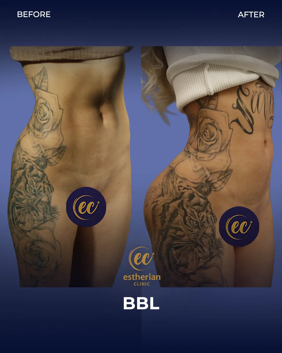 BBL - Brazilian Butt Lift Results by the Estherian Clinic