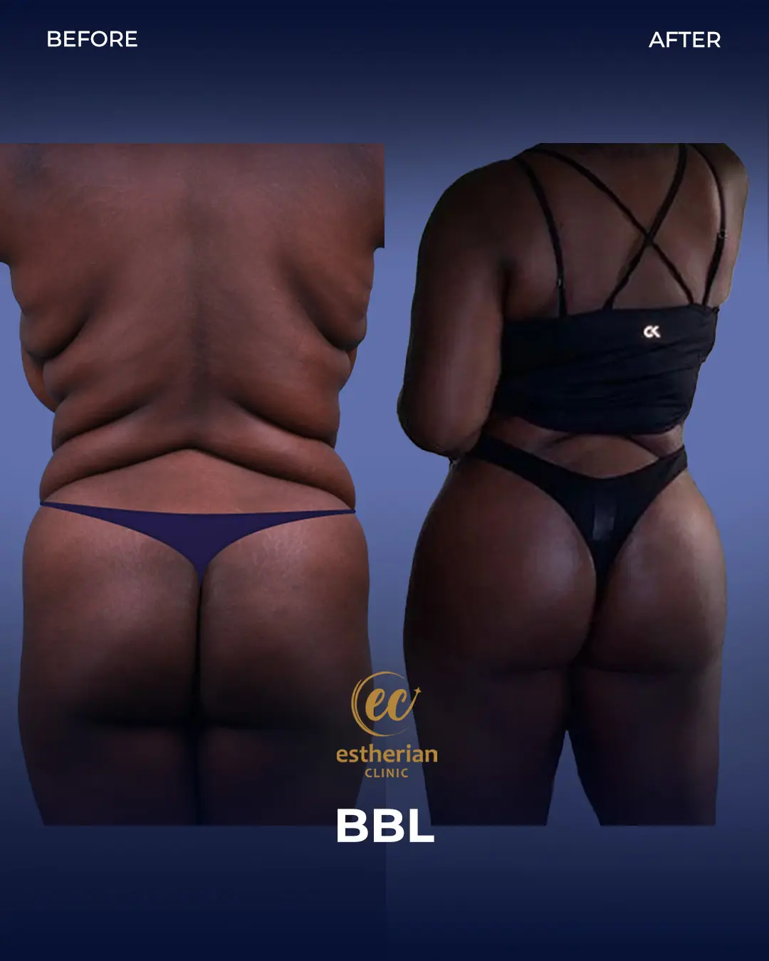 BBL - Brazilian Butt Lift Results by the Estherian Clinic