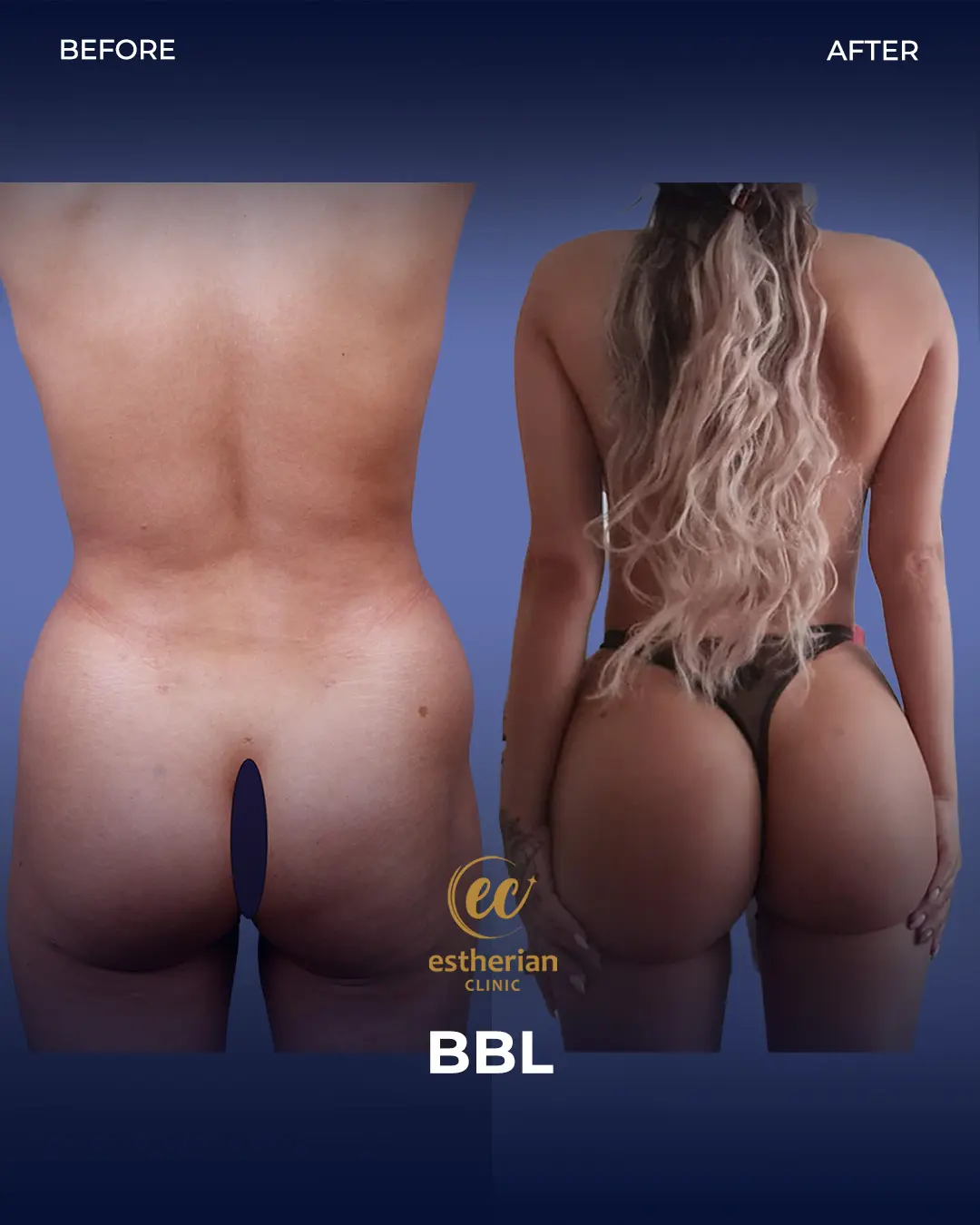 BBL - Brazilian Butt Lift Results by the Estherian Clinic