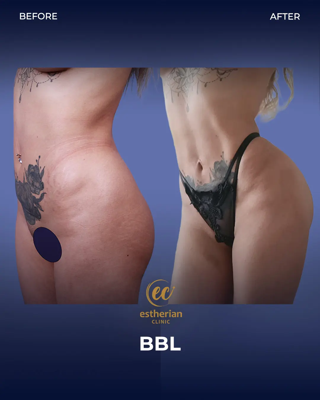 BBL - Brazilian Butt Lift Results by the Estherian Clinic