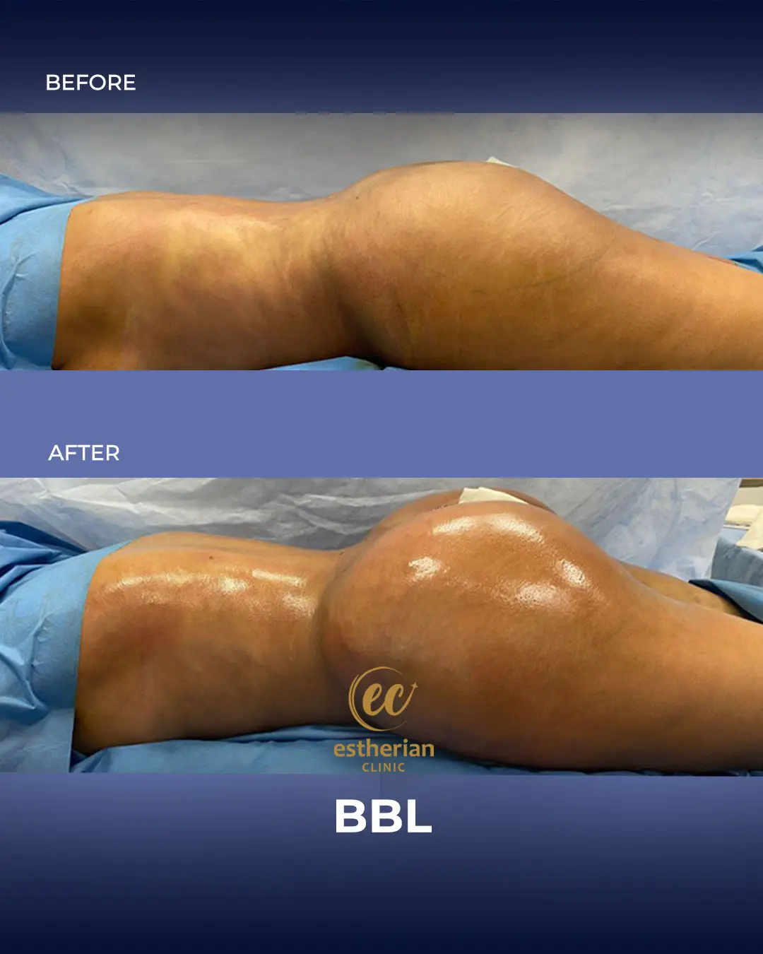 BBL - Brazilian Butt Lift Results by the Estherian Clinic
