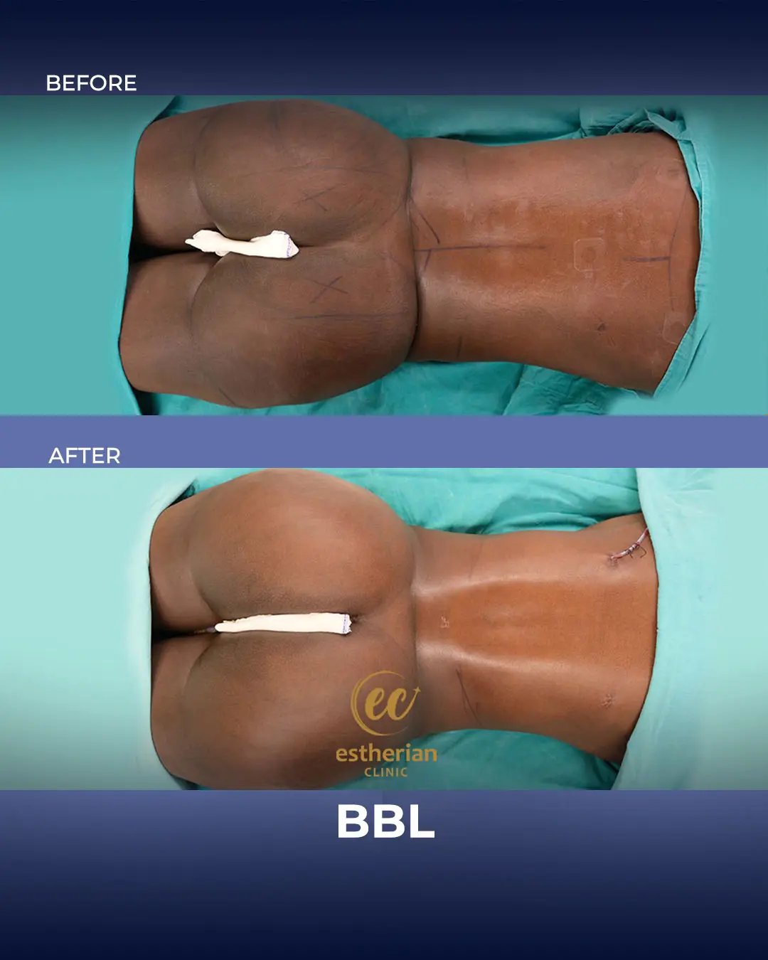 BBL - Brazilian Butt Lift Results by the Estherian Clinic