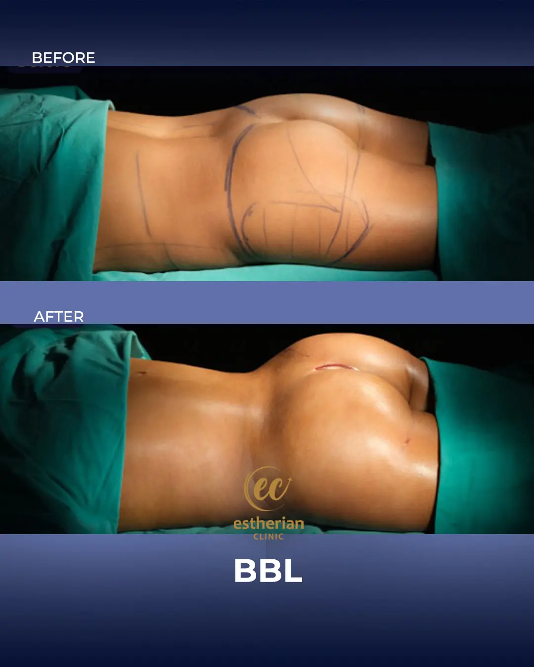 BBL - Brazilian Butt Lift Results by the Estherian Clinic