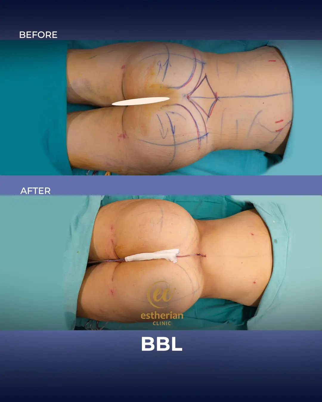 BBL - Brazilian Butt Lift Results by the Estherian Clinic