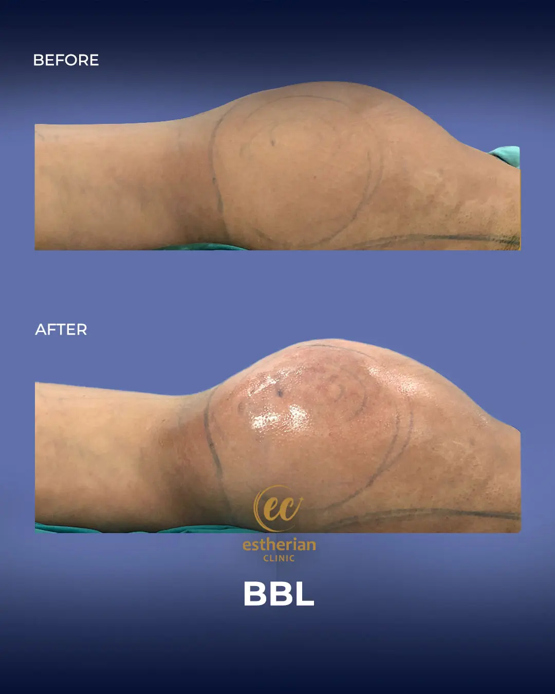 BBL - Brazilian Butt Lift Results by the Estherian Clinic