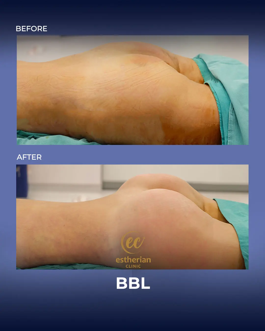 BBL - Brazilian Butt Lift Results by the Estherian Clinic