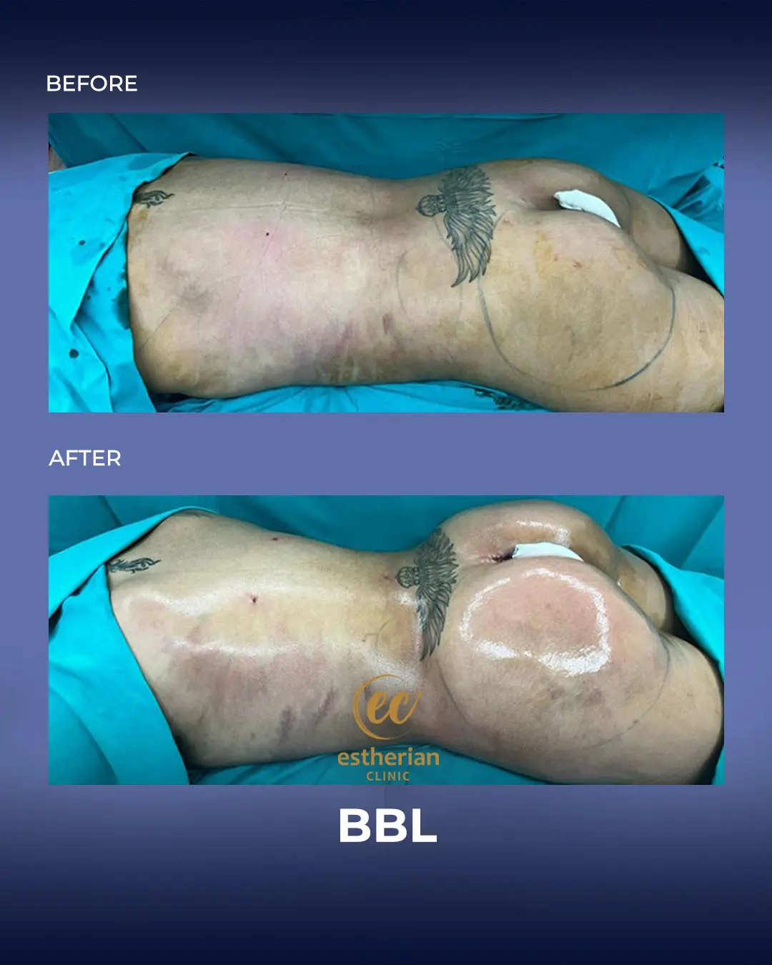 BBL - Brazilian Butt Lift Results by the Estherian Clinic