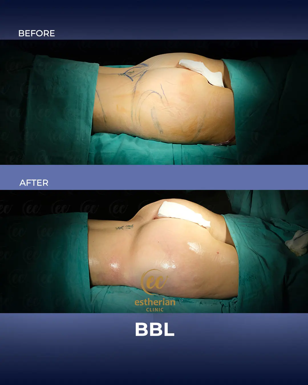 BBL - Brazilian Butt Lift Results by the Estherian Clinic