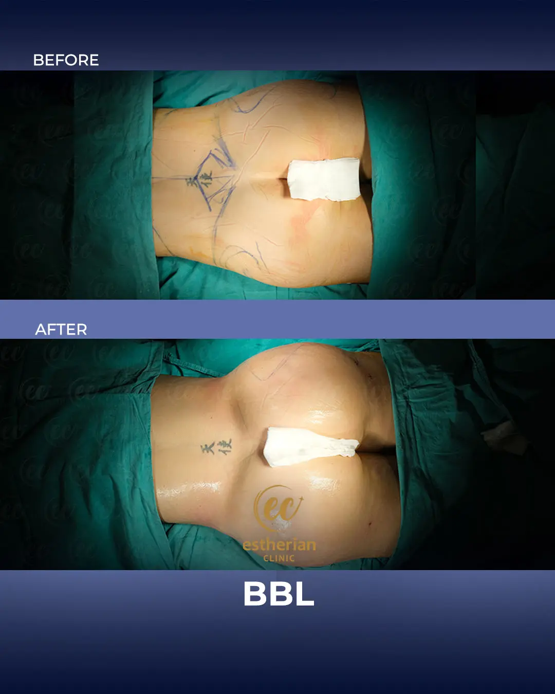 BBL - Brazilian Butt Lift Results by the Estherian Clinic