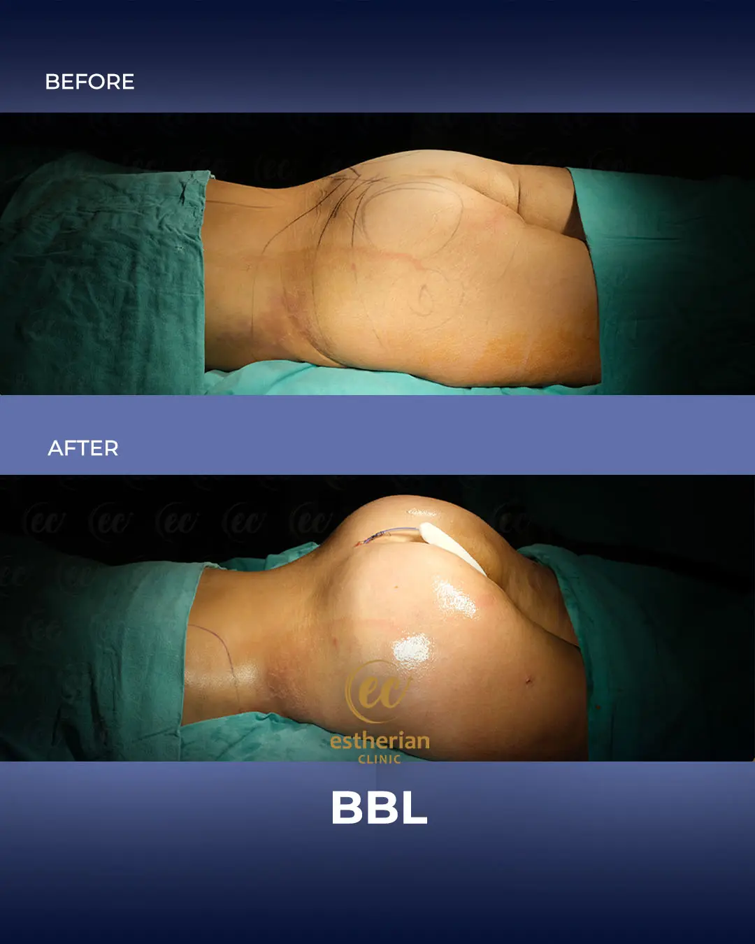 BBL - Brazilian Butt Lift Results by the Estherian Clinic