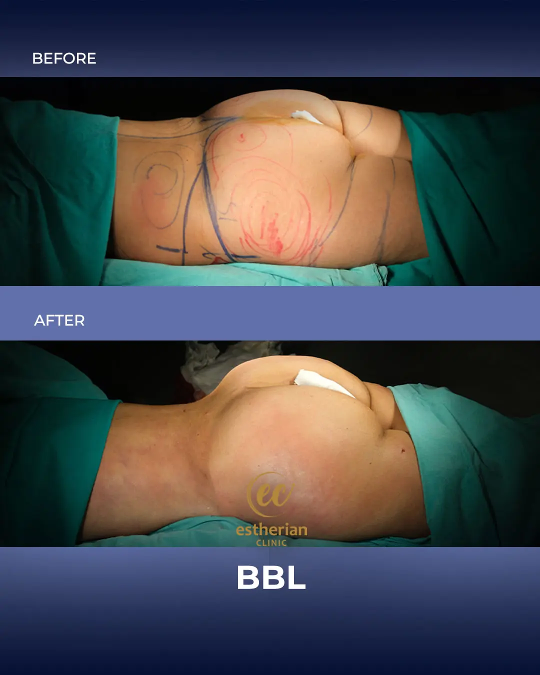 BBL - Brazilian Butt Lift Results by the Estherian Clinic