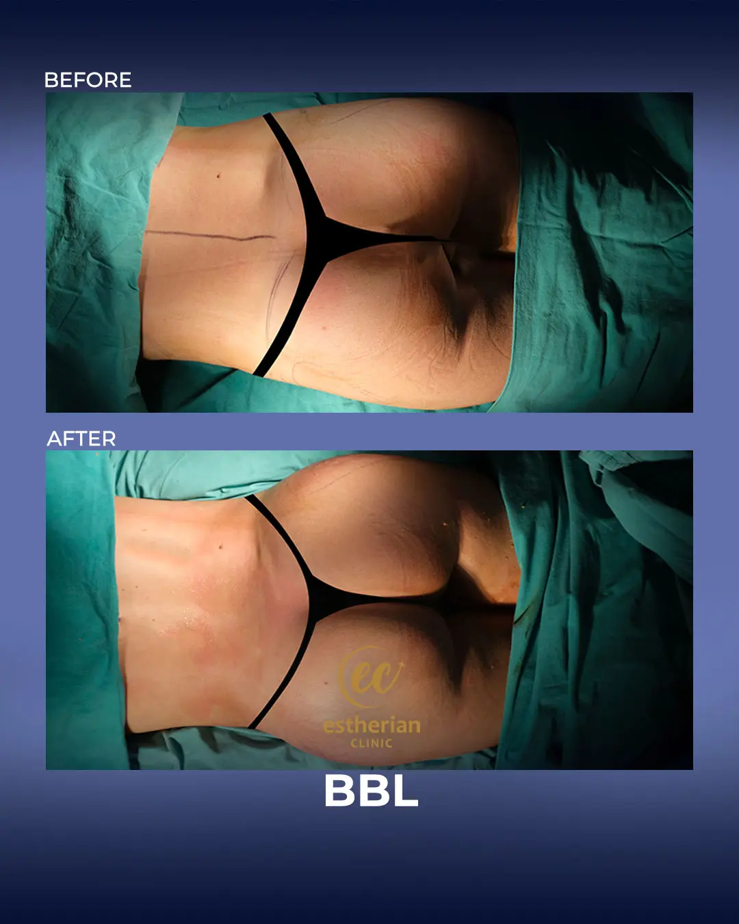 BBL - Brazilian Butt Lift Results by the Estherian Clinic