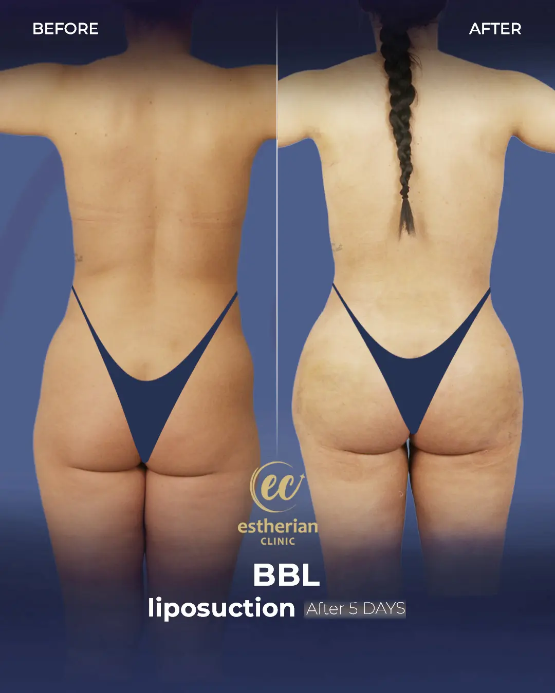 BBL - Brazilian Butt Lift Results by the Estherian Clinic