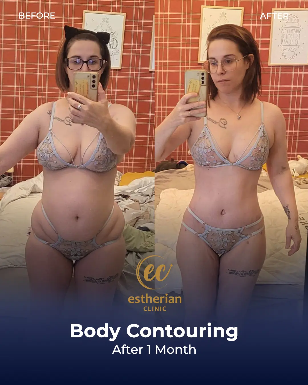 Body Contouring Surgery (before and after) by the Estherian Clinic