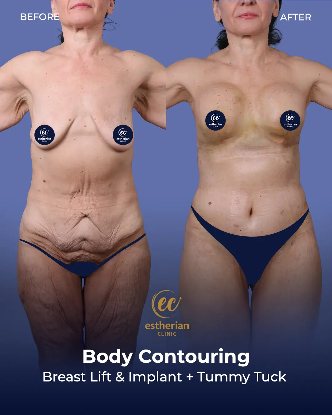 Body Contouring Surgery (before and after) by the Estherian Clinic