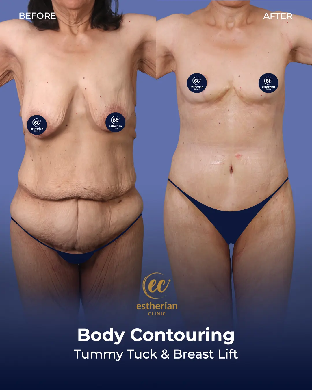 Body Contouring Surgery (before and after) by the Estherian Clinic