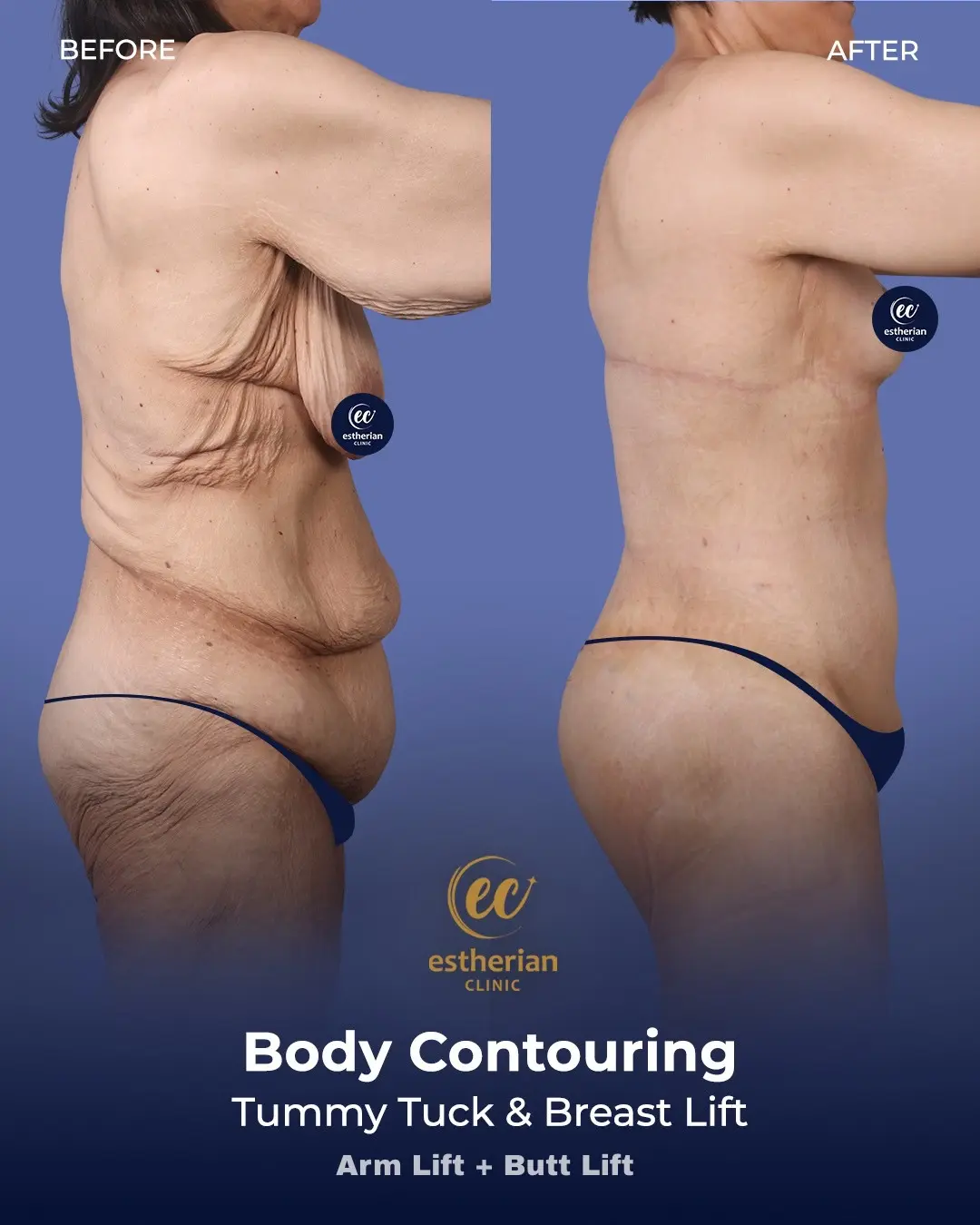 Body Contouring Surgery (before and after) by the Estherian Clinic