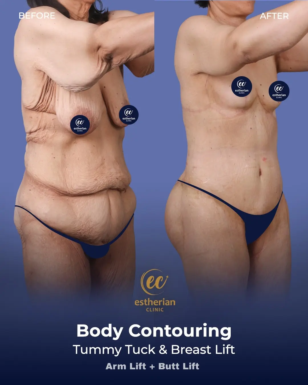 Body Contouring Surgery (before and after) by the Estherian Clinic